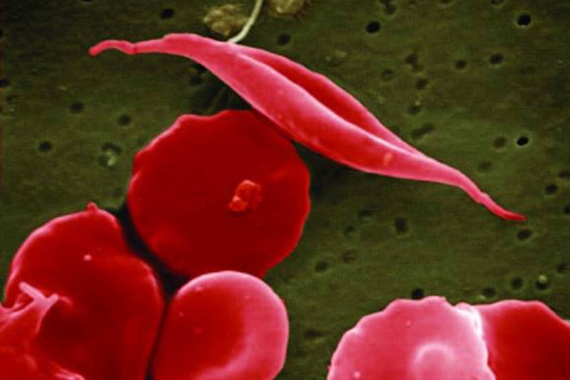 FDA Approved Sickle Cell Gene Therapies